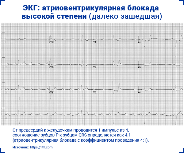 ЭКГ атриовентрикулярная блокада высокой степени далеко зашедшая